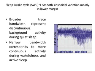 Sleep /wake cycle (SWC) Smooth sinusoidal variation mostly
in lower margin
• Broader trace
bandwidth represent
discontinuous
background activity
during quiet sleep
• Narrow bandwidth
corresponds to more
continuous activity
during wakefulness and
active sleep
 