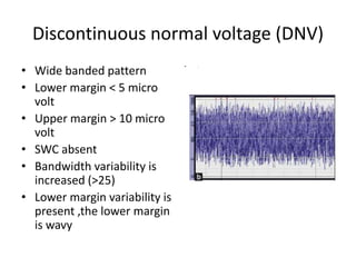 Discontinuous normal voltage (DNV)
• Wide banded pattern
• Lower margin < 5 micro
volt
• Upper margin > 10 micro
volt
• SWC absent
• Bandwidth variability is
increased (>25)
• Lower margin variability is
present ,the lower margin
is wavy
• .
 