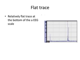 Flat trace
• Relatively flat trace at
the bottom of the a EEG
scale
• .
 