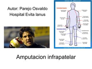 Amputacion infrapatelar
Autor: Parejo Osvaldo
Hospital Evita lanus
 