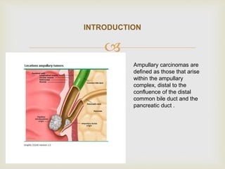 
INTRODUCTION
Ampullary carcinomas are
defined as those that arise
within the ampullary
complex, distal to the
confluence of the distal
common bile duct and the
pancreatic duct .
 