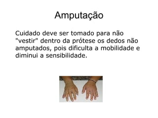 Amputação
Cuidado deve ser tomado para não
"vestir" dentro da prótese os dedos não
amputados, pois dificulta a mobilidade e
diminui a sensibilidade.
 