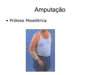 Amputação
• Prótese Mioelétrica
 