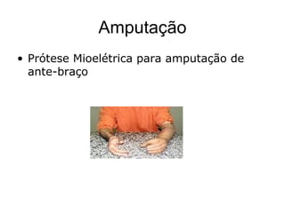Amputação
• Prótese Mioelétrica para amputação de
ante-braço
 