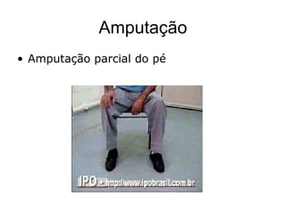 Amputação
• Amputação parcial do pé
 