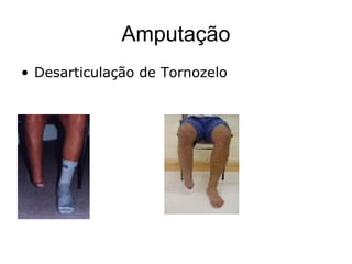 Amputação
• Desarticulação de Tornozelo
 