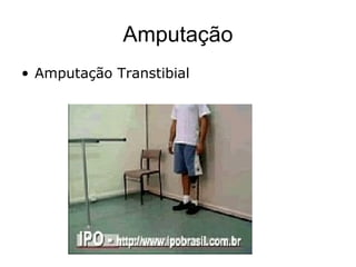 Amputação
• Amputação Transtibial
 
