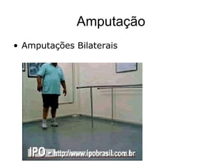 Amputação
• Amputações Bilaterais
 