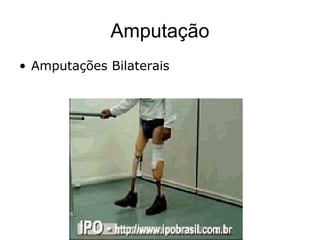 Amputação
• Amputações Bilaterais
 