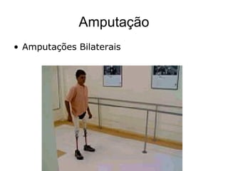 Amputação
• Amputações Bilaterais
 
