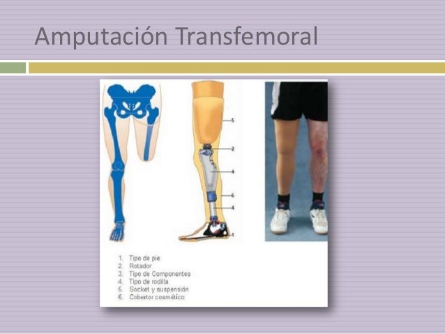 Amputación de miembros pélvicos, fisioterapia