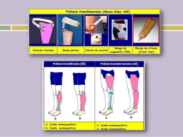 Amputación de miembros pélvicos, fisioterapia