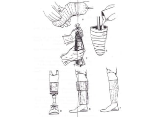 Prótesis para
desarticulación
de rodilla.
 