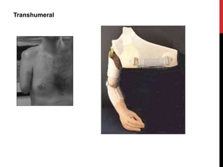 Transhumeral
 