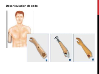 Desarticulación de codo
 