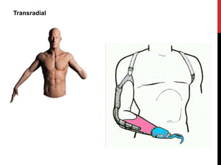 Transradial
 