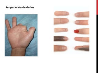 Amputación de dedos
 