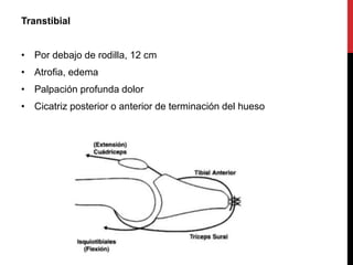 Transtibial
• Por debajo de rodilla, 12 cm
• Atrofia, edema
• Palpación profunda dolor
• Cicatriz posterior o anterior de terminación del hueso
 