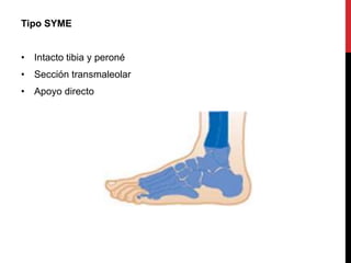 Tipo SYME
• Intacto tibia y peroné
• Sección transmaleolar
• Apoyo directo
 