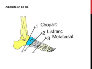 Amputación de pie
 