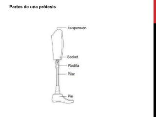 Partes de una prótesis
 