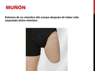 MUÑÓN
Extremo de un miembro del cuerpo después de haber sido
amputado dicho miembro.
 