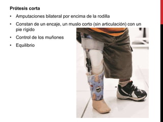 Prótesis corta
• Amputaciones bilateral por encima de la rodilla
• Constan de un encaje, un muslo corto (sin articulación) con un
pie rígido
• Control de los muñones
• Equilibrio
 