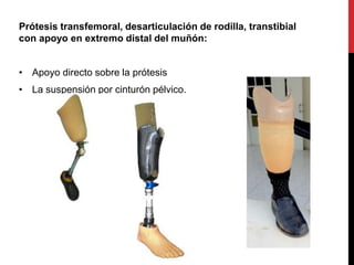 Prótesis transfemoral, desarticulación de rodilla, transtibial
con apoyo en extremo distal del muñón:
• Apoyo directo sobre la prótesis
• La suspensión por cinturón pélvico.
 