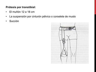 Prótesis por transtibial:
• El muñón 12 a 18 cm
• La suspensión por cinturón pélvico o corselete de muslo
• Succión
 