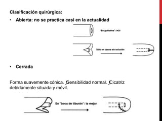 Clasificación quirúrgica:
• Abierta: no se practica casi en la actualidad
• Cerrada
Forma suavemente cónica. ƒSensibilidad normal. ƒCicatriz
debidamente situada y móvil.
 