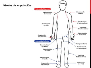 Niveles de amputación
 