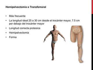 Hemipelvectomia o Transfemoral
• Más frecuente
• La longitud ideal 25 a 30 cm desde el trocánter mayor, 7.5 cm
por debajo del trocánter mayor
• Longitud correcta protesica
• Hemipelvectomia
• Forma
 