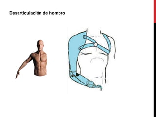 Desarticulación de hombro
 