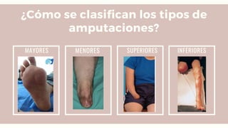 ¿Cómo se clasifican los tipos de
amputaciones?
MAYORES INFERIORES
MENORES SUPERIORES
 