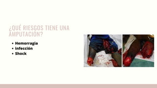 ¿QUÉ RIESGOS TIENE UNA
AMPUTACIÓN?
Hemorragia
infección
Shock
 