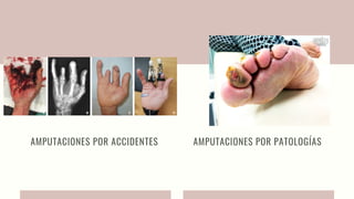 AMPUTACIONES POR ACCIDENTES AMPUTACIONES POR PATOLOGÍAS
 