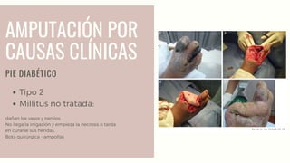 AMPUTACIÓN POR
CAUSAS CLÍNICAS
PIE DIABÉTICO
Tipo 2
Millitus no tratada:
dañan los vasos y nervios.
No llega la irrigación y empieza la necrosis o tarda
en curarse sus heridas.
Bota quirúrgica - ampollas
 