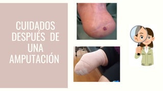 CUIDADOS
DESPUÉS DE
UNA
AMPUTACIÓN
 