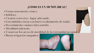 Forma suavemente cónica.
Indoloro.
Cicatriz correcta y lugar adecuado.
Extremidades óseas con buen recubrimiento de tejido.
Revestimiento cutáneo bien nutrido.
Movilidad suficiente.
Conservar los arcos de movilidad de la extremidad proximal.
Buena irrigación sanguínea.
¿CÓMO ES UN MUÑÓN IDEAL?
 