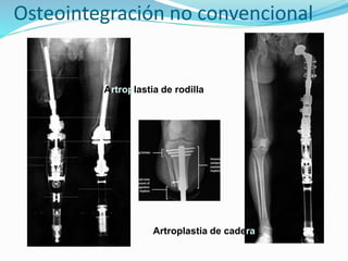 Osteointegración no convencional
Artroplastia de rodilla
Artroplastia de cadera
 