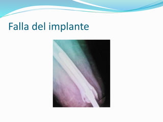 Falla del implante
 