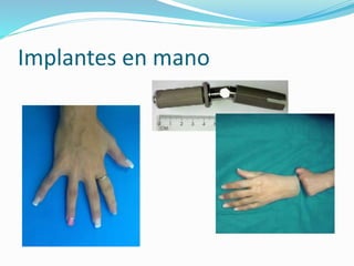 Implantes en mano
 