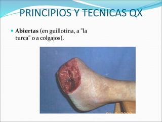 PRINCIPIOS Y TECNICAS QX
 Abiertas (en guillotina, a "la
turca" o a colgajos).
 