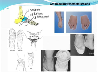 Amputación transmetatarsiana
 