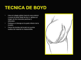 TECNICA DE BOYD 
• Lleve el colgajo glúteo hacia la cara anterior 
y suture la parte distal de los m. glúteos al 
origen de los músculos pectíneo y 
obturador. 
• Coloque un drenaje en la parte inferior de la 
incisión. 
• Cierre los bordes de la piel con puntos 
sueltos de material no reabsorbible. 
 