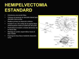 HEMIPELVECTOMIA 
ESTANDARD 
• Introduzca una sonda foley. 
• Coloque el paciente en decúbito lateral lado 
afectado hacia arriba. 
• Realice primero la disección anterior. 
• Incisión 5 cm. Por arriba de la espina iliaca 
anterosuperior hasta el tubérculo del pubis. 
• Profundice la incisión a través del tensor de 
la fascia lata. 
• Retraiga el cordón espermático hacia el 
lado medial. 
• Exponga la fosa iliaca mediante disección 
roma. 
 