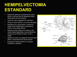 HEMIPELVECTOMIA 
ESTANDARD 
• Separe el peritoneo parietal de los vasos 
iliacos y permita que se desplacen hacia 
abajo junto con las vísceras. 
• Ligue los vasos epigástricos inferiores. 
• Libere el recto anterior y su vaina del pubis. 
• Identifique los vasos iliacos, rechace el 
uréter hacia medial ligue y seccione la 
arteria y vena iliaca común. 
• Aplique tracción lateral a la arteria y las 
venas iliacas ligándolas y seccionando las 
ramas que se dirigen al sacro, recto y 
vejiga. 
• Separar el recto y la vejiga de la pared de la 
pelvis y exponiendo las raíces sacras. 
• Empaque la herida anterior con gasas 
húmedas y calientes. 
 