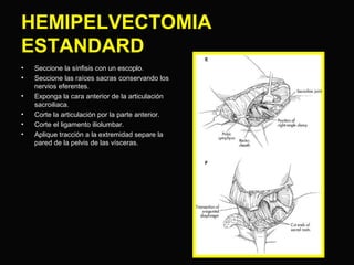 HEMIPELVECTOMIA 
ESTANDARD 
• Seccione la sínfisis con un escoplo. 
• Seccione las raíces sacras conservando los 
nervios eferentes. 
• Exponga la cara anterior de la articulación 
sacroiliaca. 
• Corte la articulación por la parte anterior. 
• Corte el ligamento iliolumbar. 
• Aplique tracción a la extremidad separe la 
pared de la pelvis de las vísceras. 
 