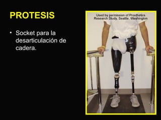 PROTESIS 
• Socket para la 
desarticulación de 
cadera. 
 