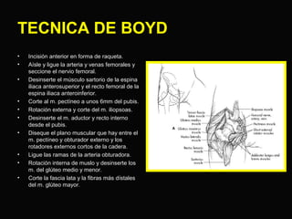 TECNICA DE BOYD 
• Incisión anterior en forma de raqueta. 
• Aísle y ligue la arteria y venas femorales y 
seccione el nervio femoral. 
• Desinserte el músculo sartorio de la espina 
iliaca anterosuperior y el recto femoral de la 
espina iliaca anteroinferior. 
• Corte al m. pectíneo a unos 6mm del pubis. 
• Rotación externa y corte del m. iliopsoas. 
• Desinserte el m. aductor y recto interno 
desde el pubis. 
• Diseque el plano muscular que hay entre el 
m. pectíneo y obturador externo y los 
rotadores externos cortos de la cadera. 
• Ligue las ramas de la arteria obturadora. 
• Rotación interna de muslo y desinserte los 
m. del glúteo medio y menor. 
• Corte la fascia lata y la fibras más dístales 
del m. glúteo mayor. 
 